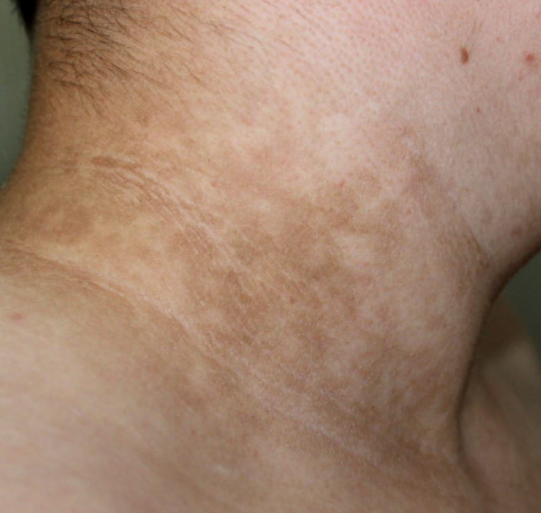 ciemnienie na skorze insulinoopornosc